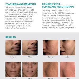 Micro - Needling Mesotherapy
